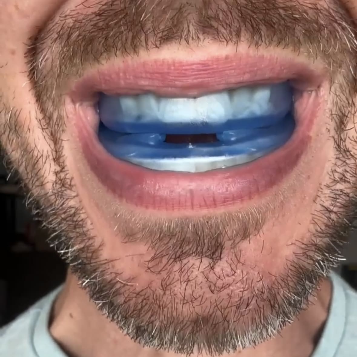 The Quiet Anti-Snoring Mouthpiece Universal Size (BACKUP)
